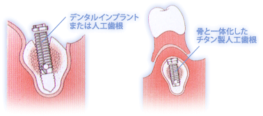 ステップ2　インプラントの埋入