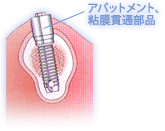 ステップ3　アバットの連結