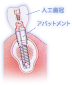 ステップ4　歯冠を作る