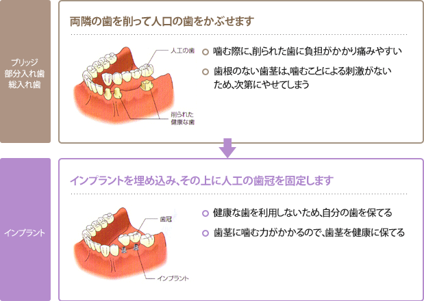 隣接する歯を1,2本失った場合