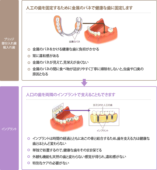 奥歯を含めて複数の歯を失った場合