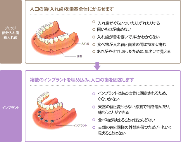 全ての歯を失った場合