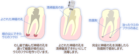 根管治療のポイント