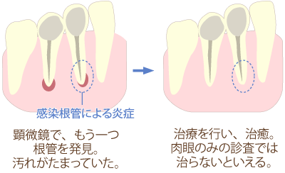 肉眼に頼った根管治療の限界