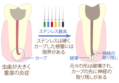 ステンレス器具