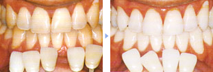 ホワイトニングの症例