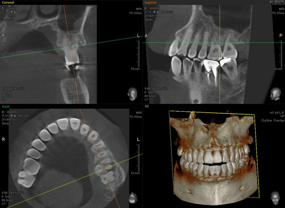 歯周病による骨の欠損の診断
